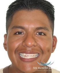jaw alignment deviation