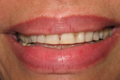 teeth grinding
