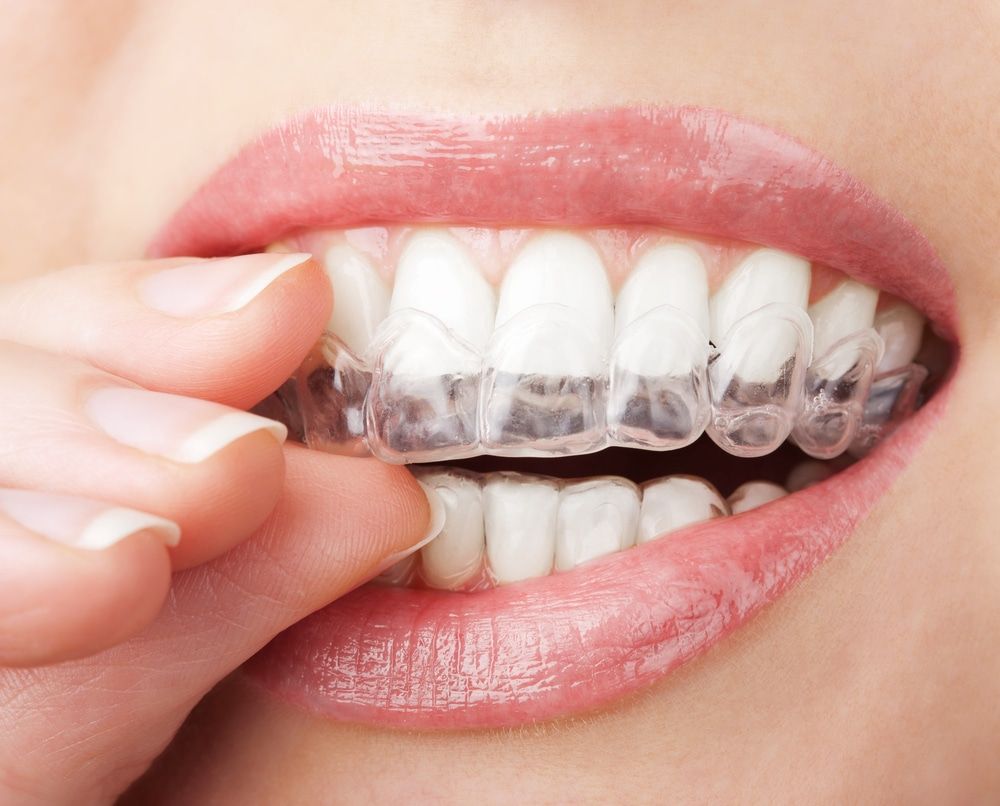 To learn how invisible braces can help enhance and strengthen your smile, call Fairfax dentist Dr. Pamela Marzban at 703-323-8200 and schedule a consultation today