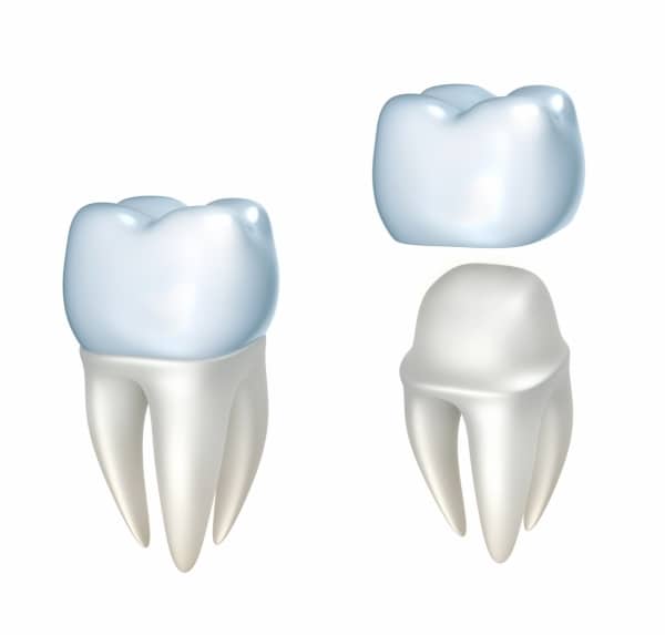 Dental Crowns - Fairfax Dentist - Dr. Pamela Marzban