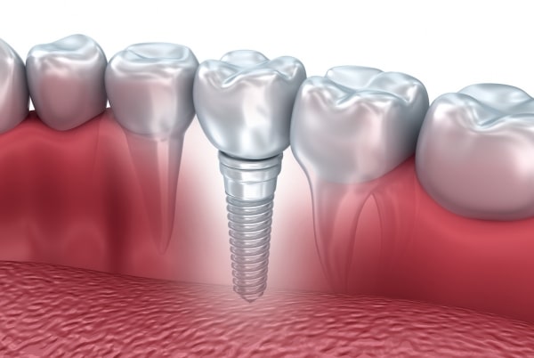 Dental Implants - Burke, Virginia dentist