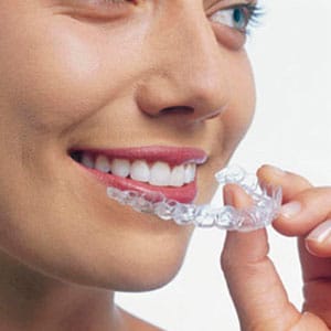 Invisalign Candidacy - Fairfax, VA
