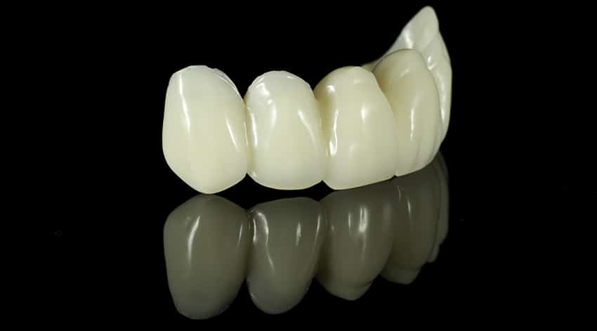 Dental Bridge