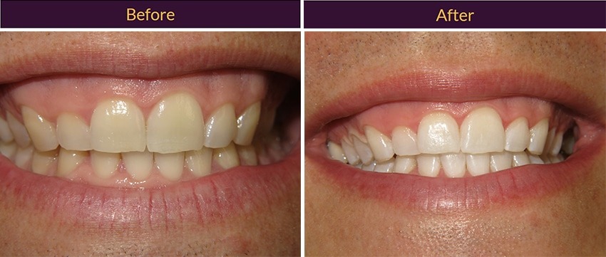 Marzban teeth whitening patient