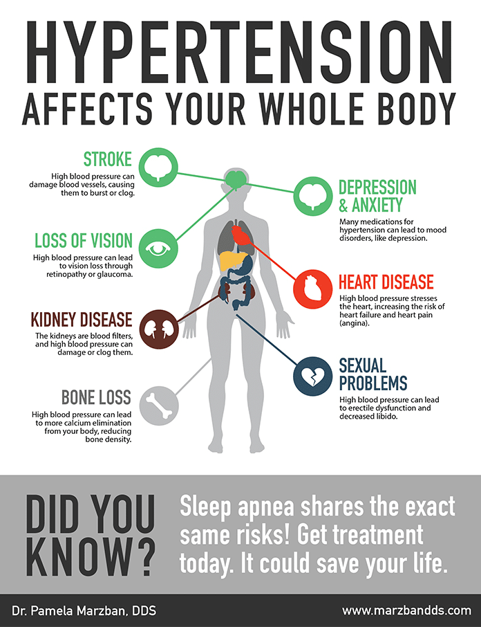 An infographic of hypertensiton and its relationship with Sleep Apnea, find out more at Marzban DDS in Burke, Virginia