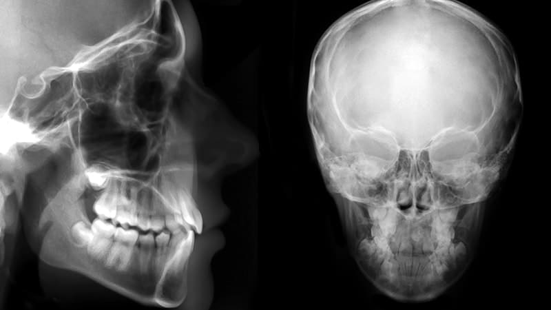 Weakens the Skull | Sleep Apnea Burke, VA
