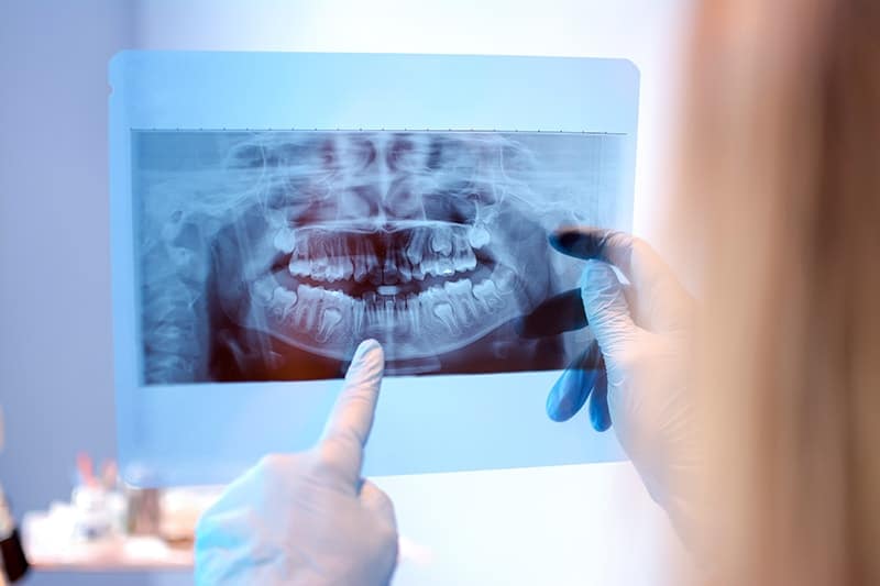 Do You Really Need Jaw Surgery?