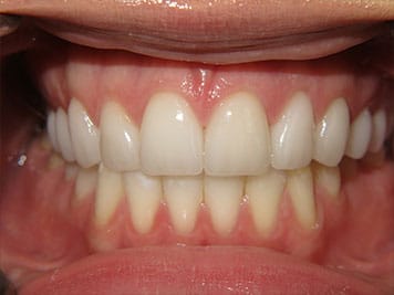 alternative to dentures