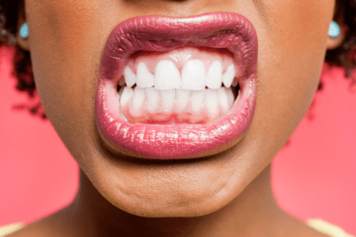 misaligned teeth