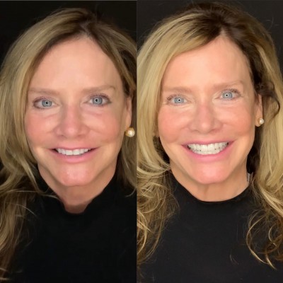 veneers