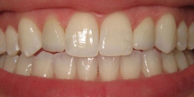 FAQs About Veneers