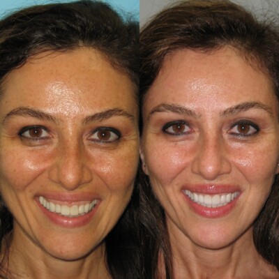 Choose the Right Type of Veneers