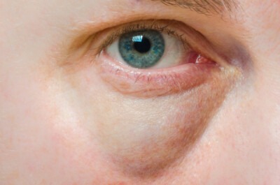 dark circles