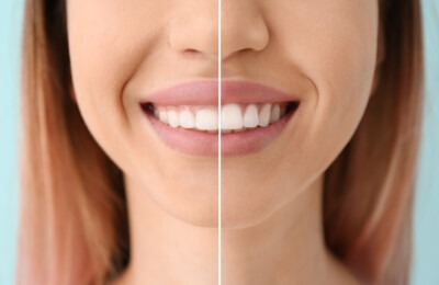 gummy smile