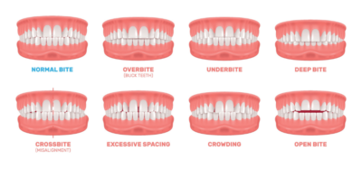 malocclusion